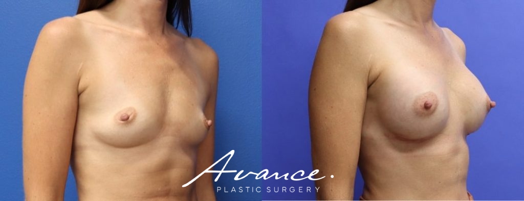 Before and After - Breast Augmentation