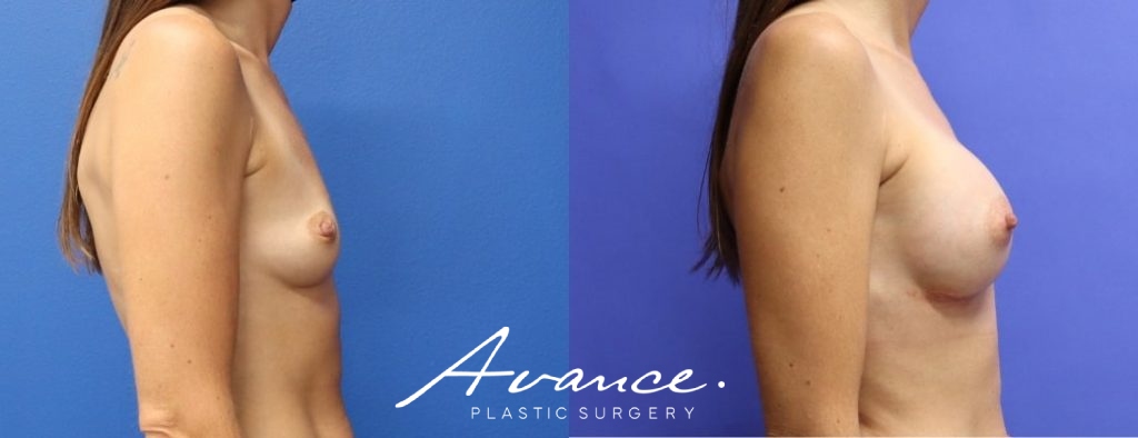 Before and After - Breast Augmentation