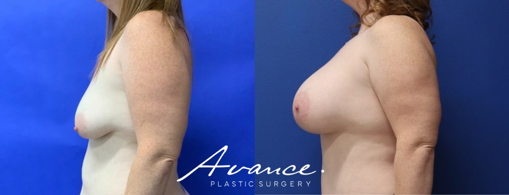 Before and After - Breast Augmentation