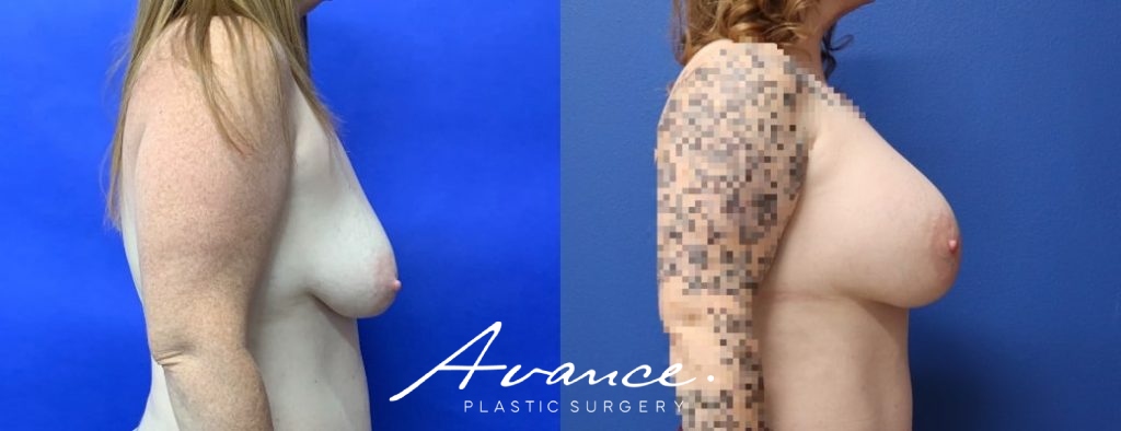 Before and After - Breast Augmentation
