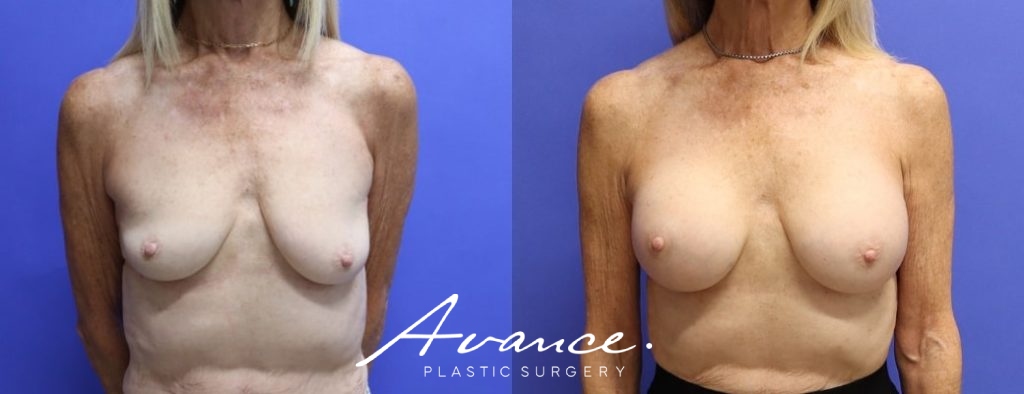 Before and After - Breast Augmentation