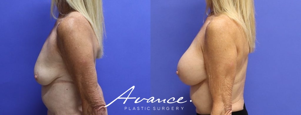 Before and After - Breast Augmentation