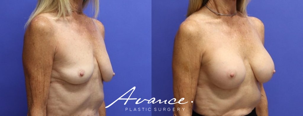 Before and After - Breast Augmentation
