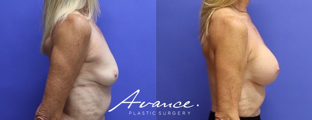 Before and After - Breast Augmentation