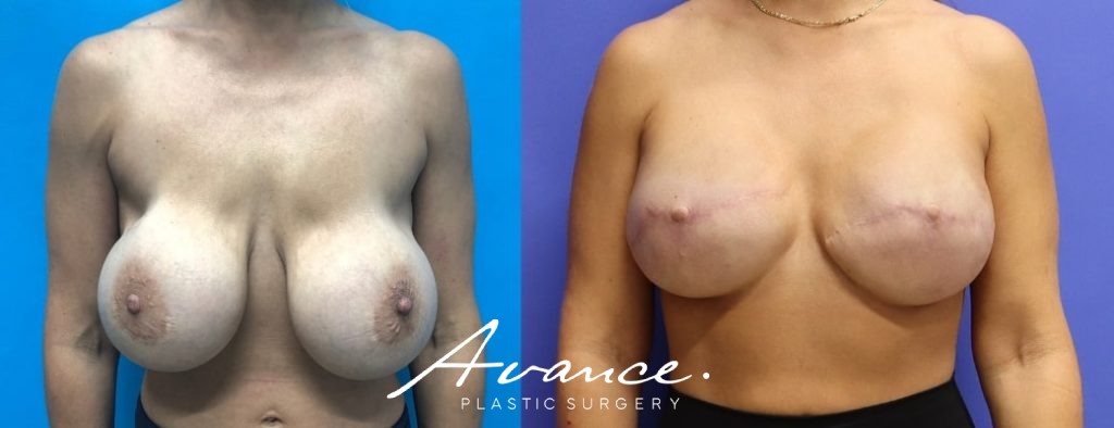 Before and After - Breast Reconstruction