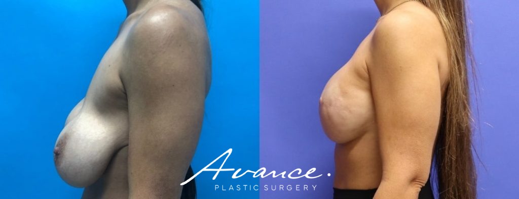 Before and After - Breast Reconstruction