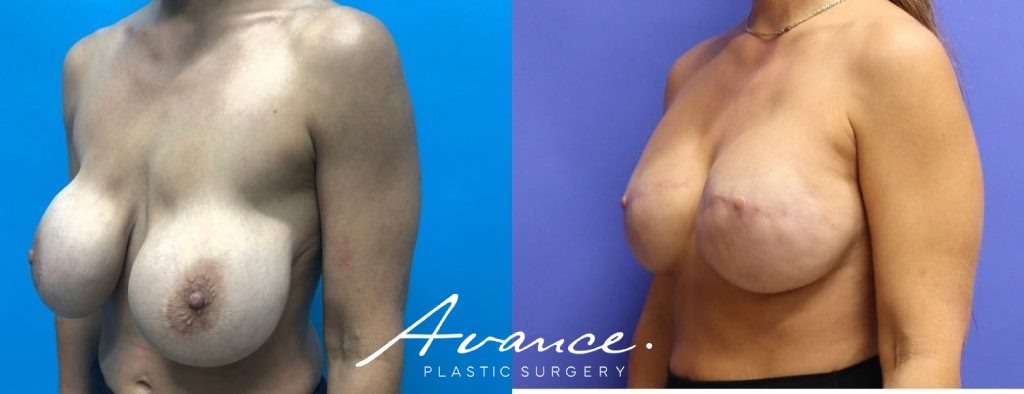 Before and After - Breast Reconstruction