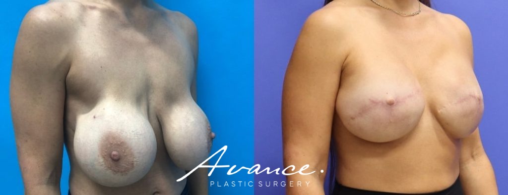 Before and After - Breast Reconstruction