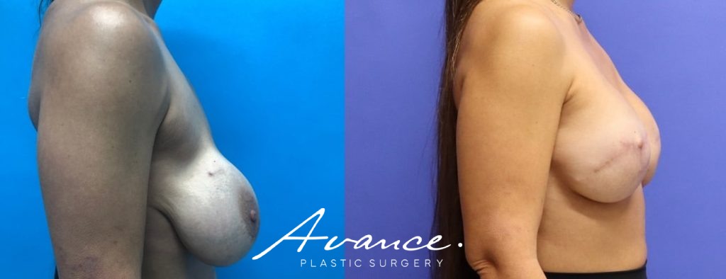 Before and After - Breast Reconstruction