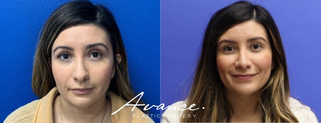 Before and After - Rhinoplasty