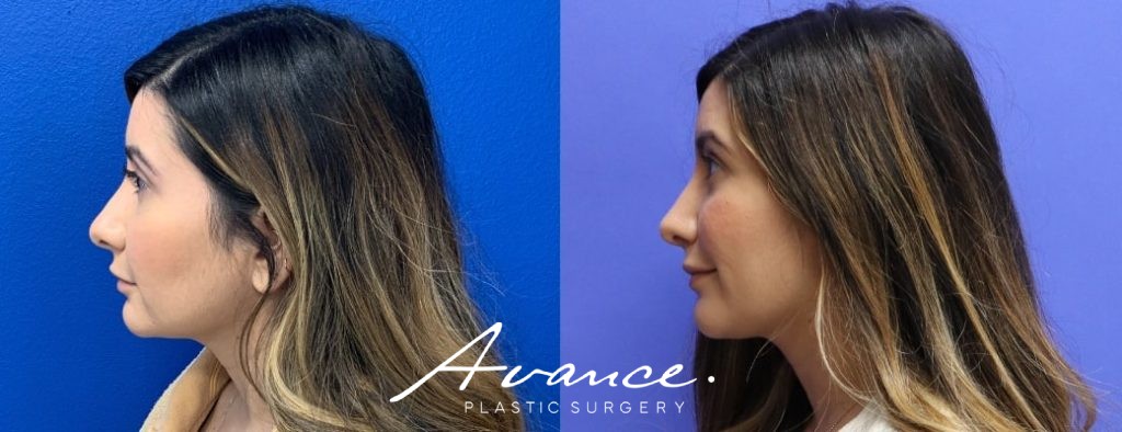 Before and After - Rhinoplasty