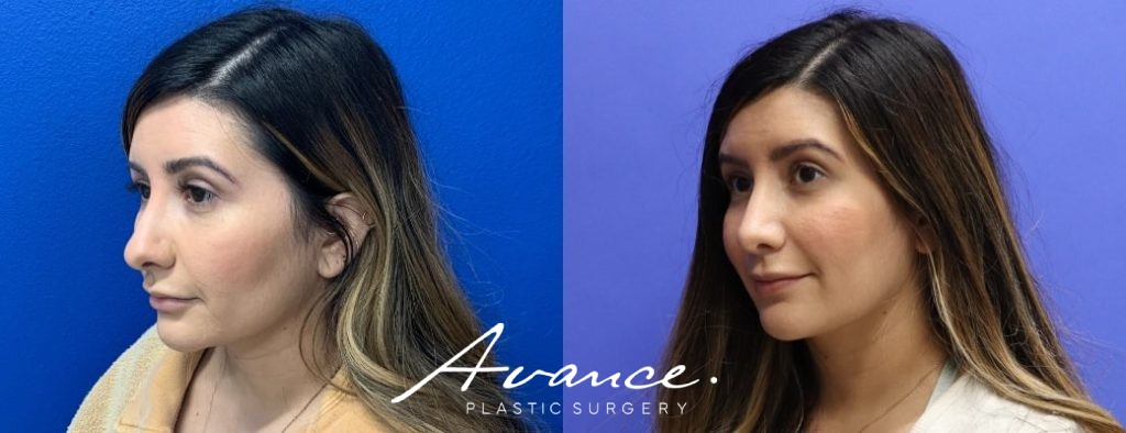 Before and After - Rhinoplasty