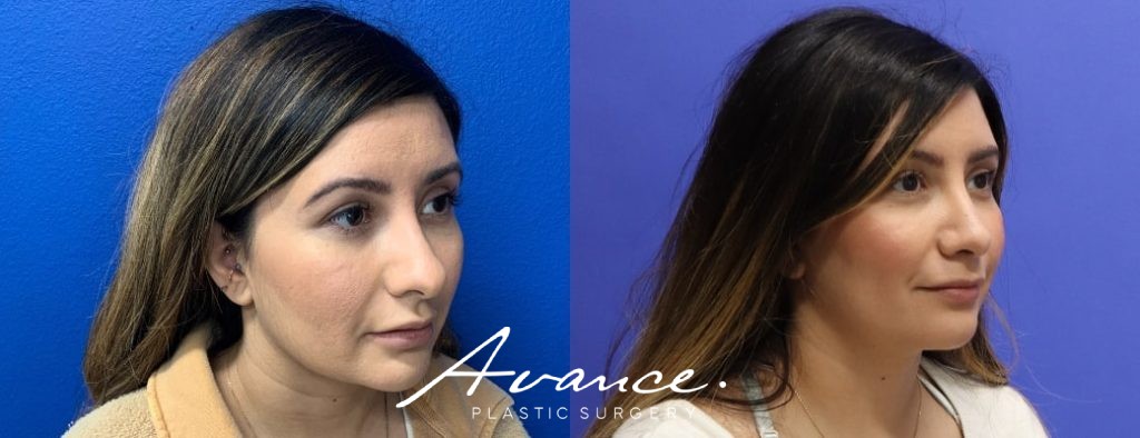 Before and After - Rhinoplasty