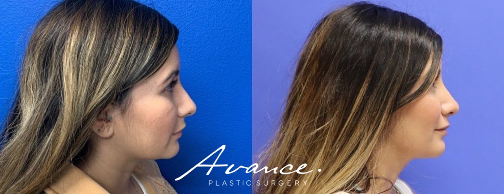 Before and After - Rhinoplasty