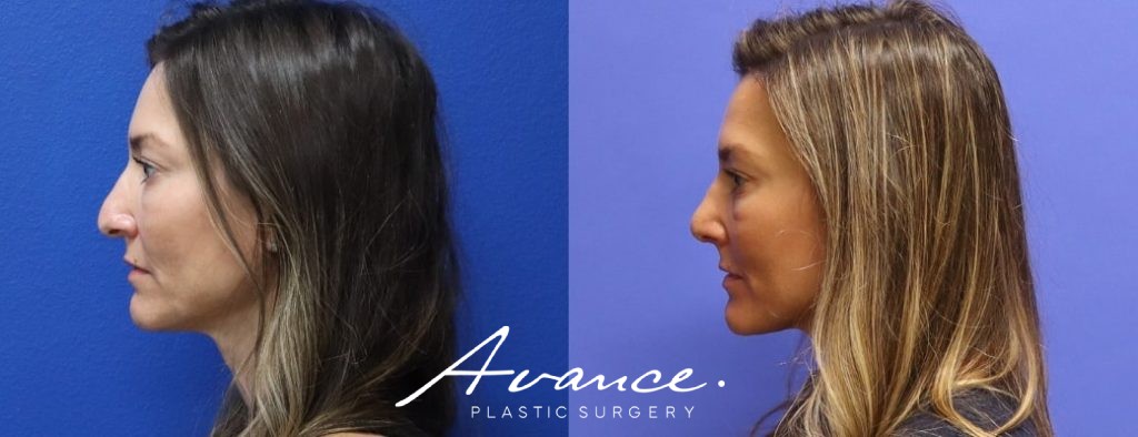 Before and After - Rhinoplasty