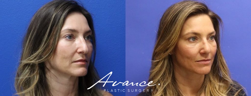 Before and After - Rhinoplasty