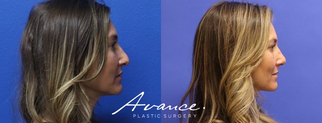 Before and After - Rhinoplasty
