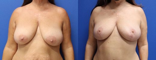 Before and After - Breast