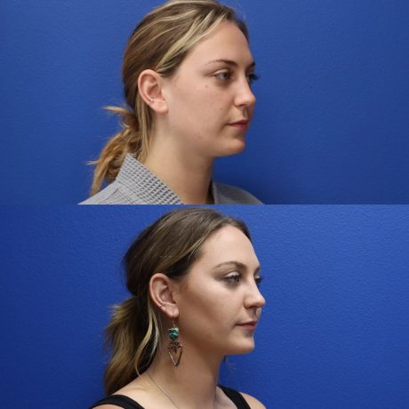Before and After - Buccal Fat Removal