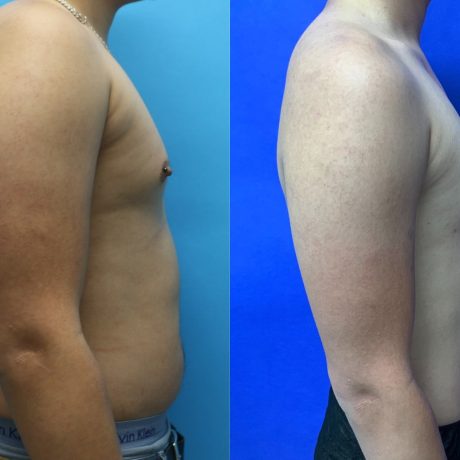 Before and After - 360 Liposucción