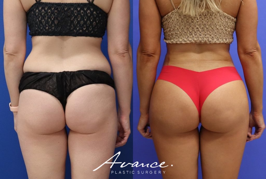Before and After - 360 Liposucción