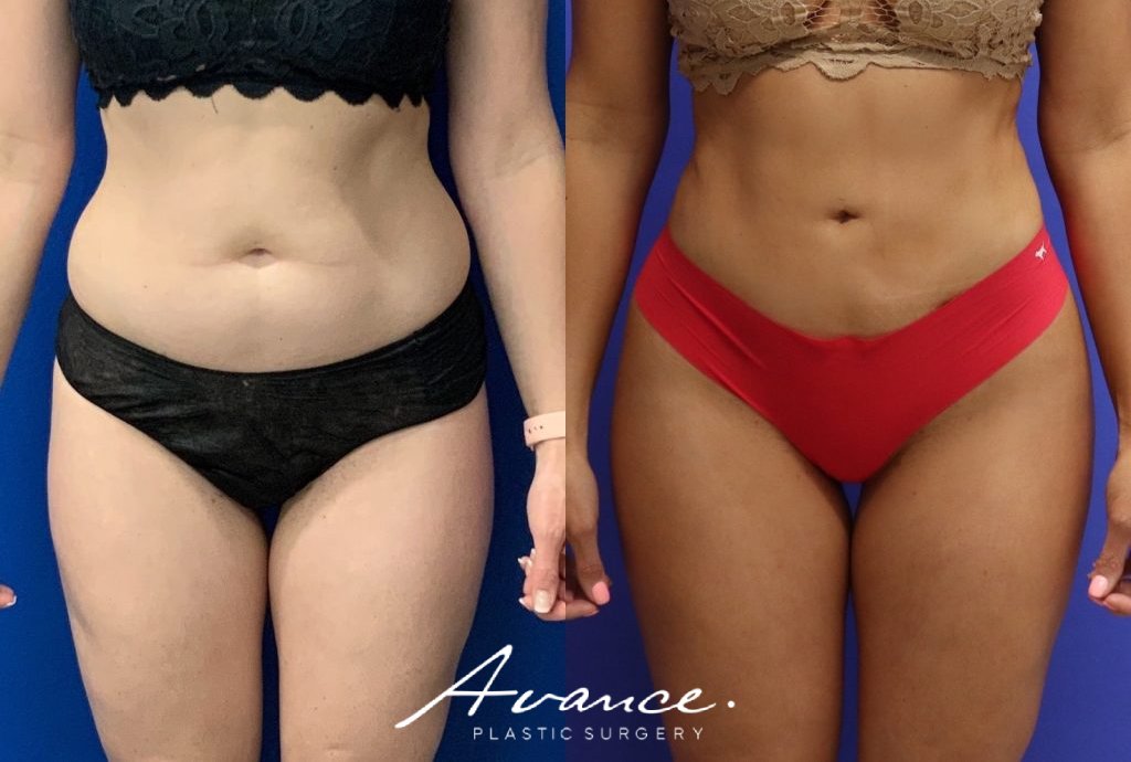 Before and After - 360 Liposucción