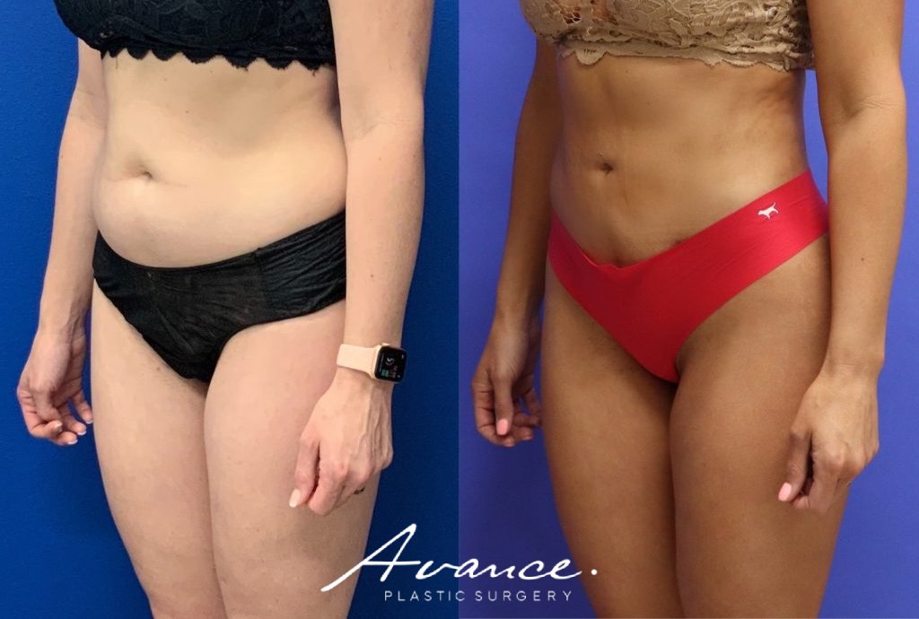 Before and After - 360 Liposucción