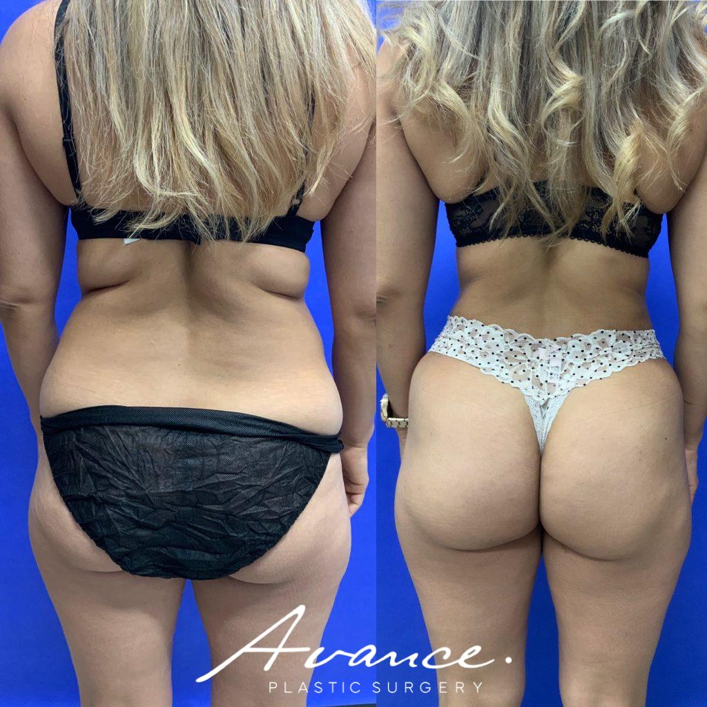 Before and After - 360 Liposucción