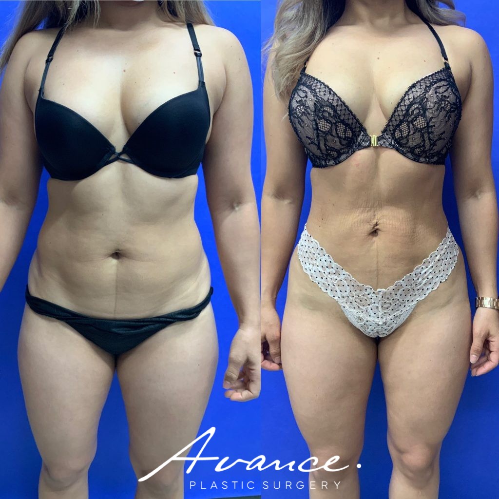 Before and After - 360 Liposucción