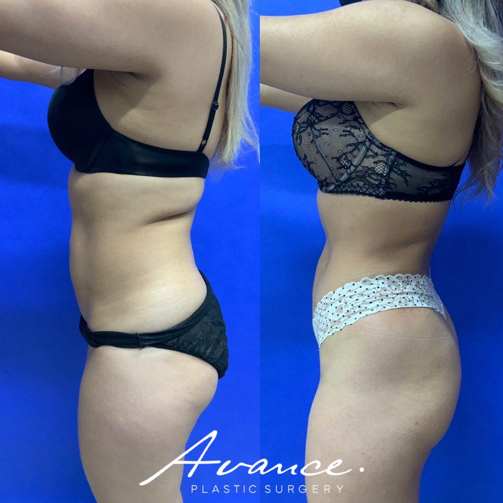 Before and After - 360 Liposucción