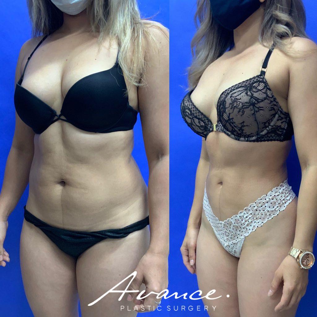 Before and After - 360 Liposucción