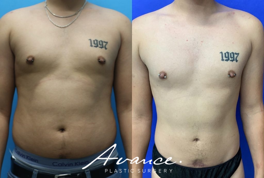 Before and After - 360 Liposucción