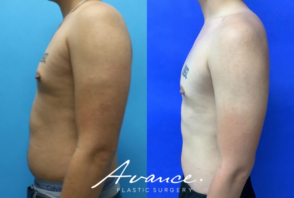 Before and After - 360 Liposucción