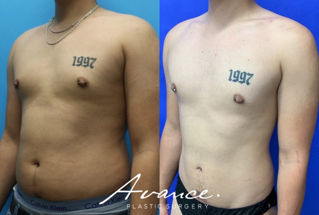 Before and After - 360 Liposucción