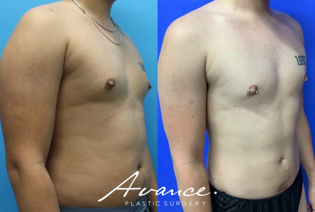 Before and After - 360 Liposucción