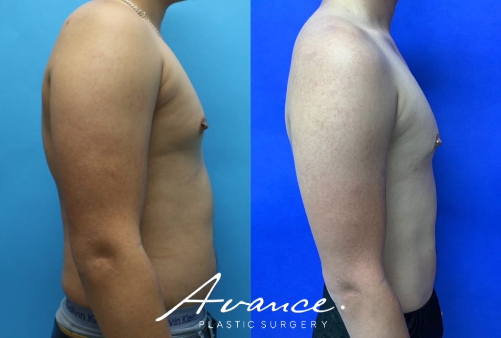 Before and After - 360 Liposucción