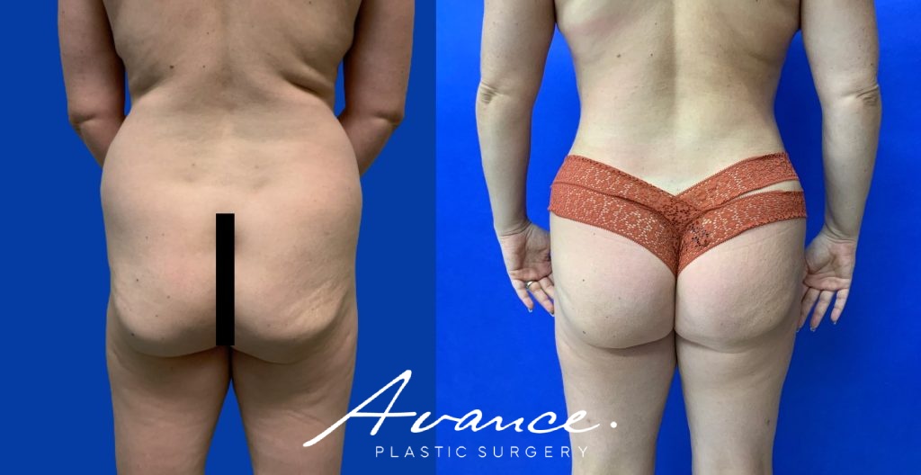 Before and After - 360 Liposucción