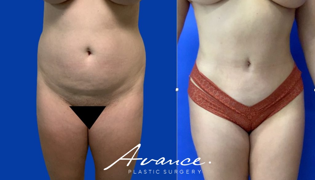 Before and After - 360 Liposucción