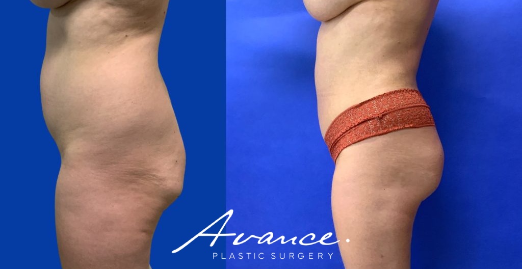Before and After - 360 Liposucción