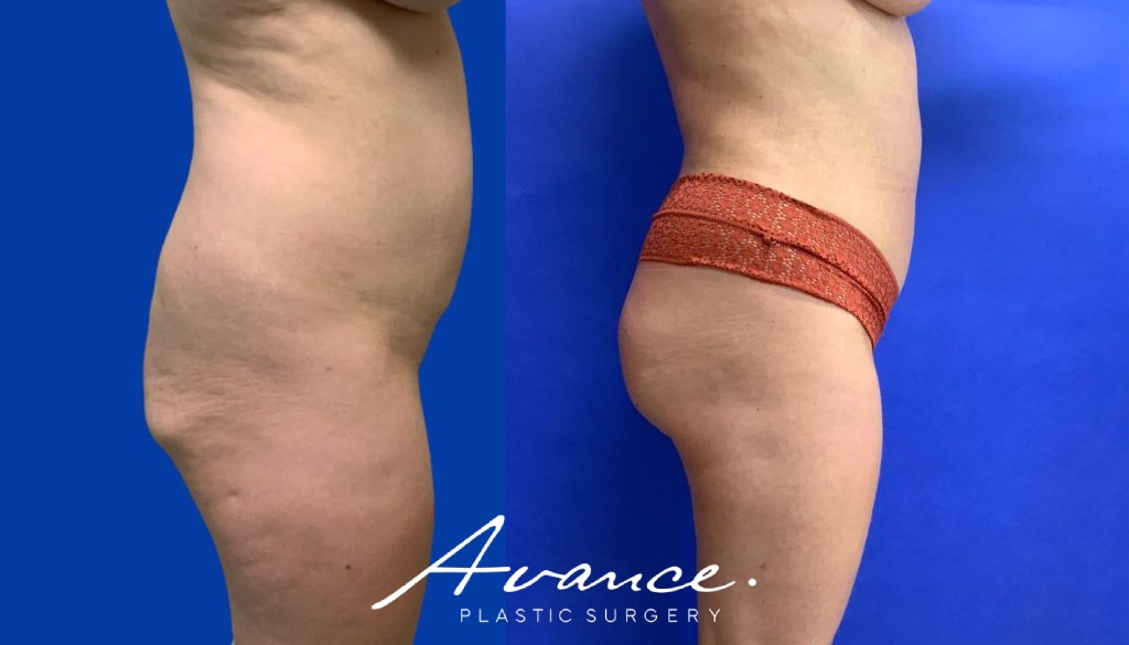 Before and After - 360 Liposucción