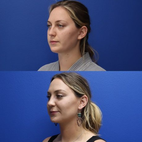Before and After - Buccal Fat Removal