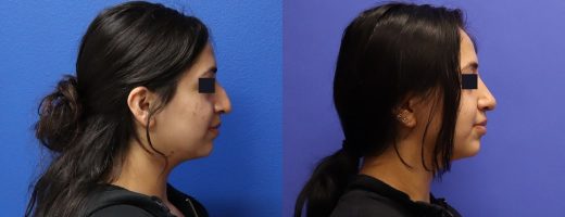 Before and After - Nose