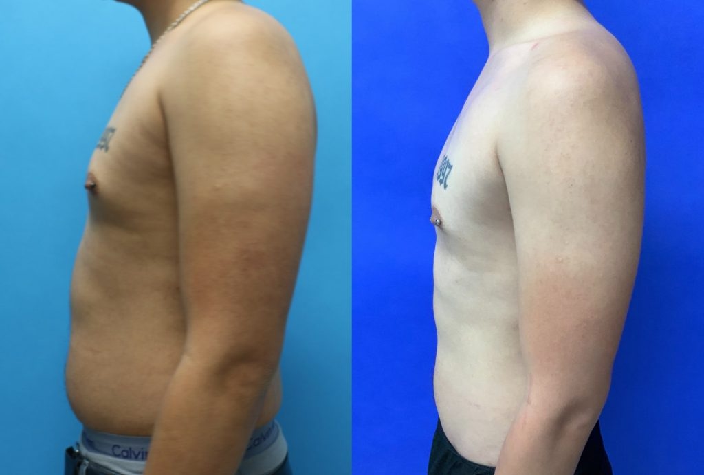 Before and After - 360 Liposuction
