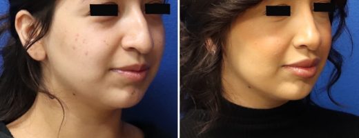 Before and After - Nose