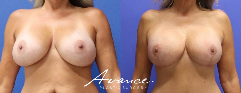 Before and After - Breast Lift