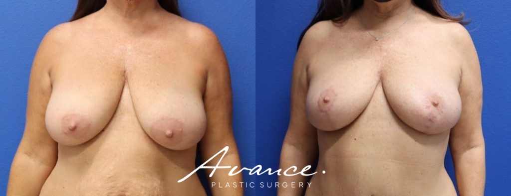 Before and After - Breast Lift