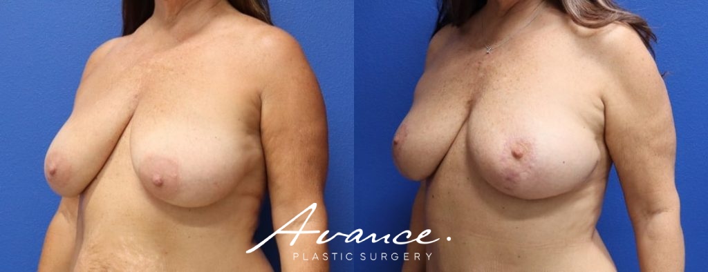 Before and After - Breast Lift