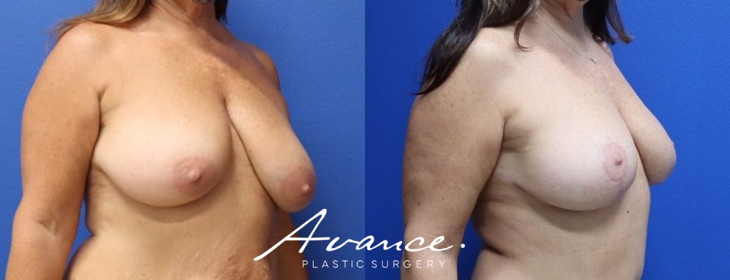 Before and After - Breast Lift