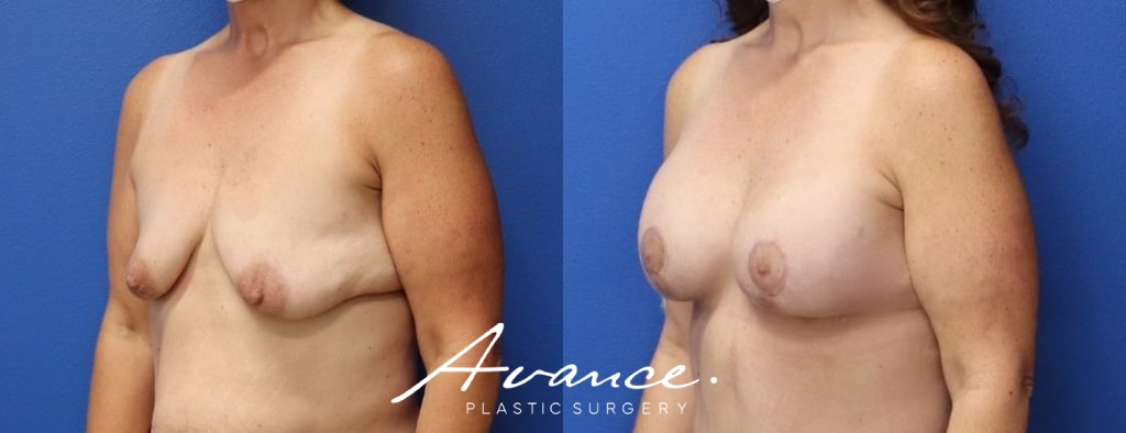 Before and After - Breast Lift