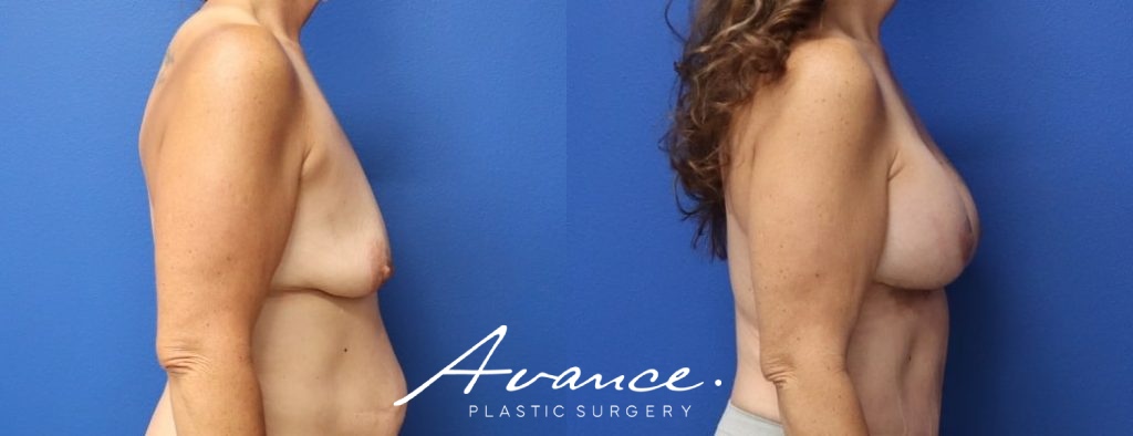 Before and After - Breast Lift